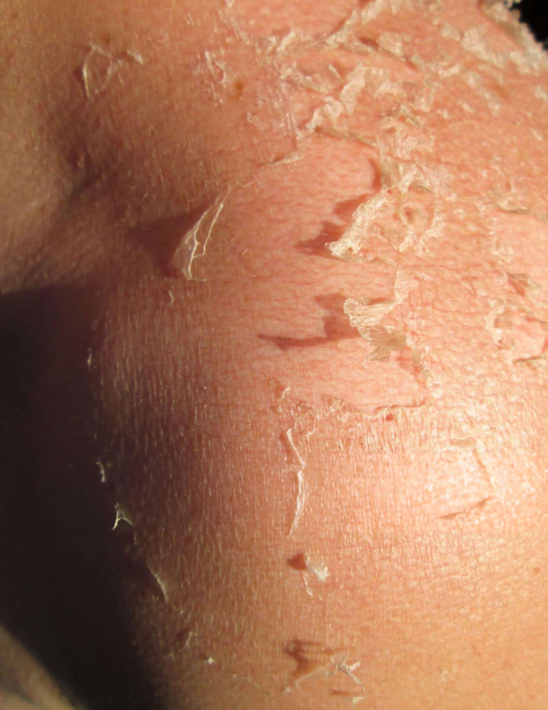 EXO-NAD Skin Longevity Peeling treatment